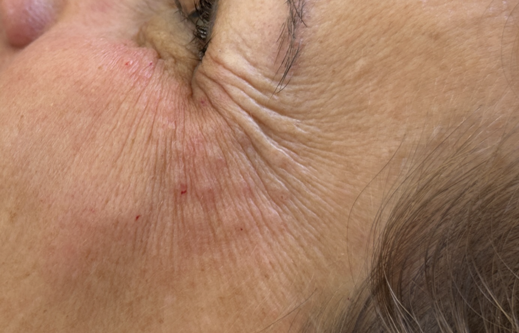 Bild von Krähenfüßen: Was sind mimische Falten und warum entstehen sie. Dermatologische Einordnung zu Stirn, Zornesfalte und Krähenfüßen.