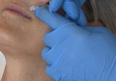 Lippenunterspritzung mit Hyaluronsäure bei Dr. Sarah Ophoff am Tegernsee, Nahaufnahme der Behandlung