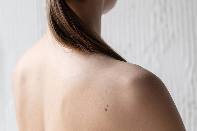 behandlungen-hautveraenderungen Dr. Sarah Ophoff Hautuntersuchung Bild eines Rückens einer Frau