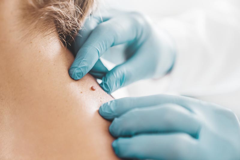 close-up-dermatologist-examining-patient-birthmark-clinic-mod Dr. Sarah Ophoff bei der ästhetischen Gesichtsbehandlung in ihrer Praxis am Tegernsee – professionell, einfühlsam und präzise. Sie trägt einen weißen Kittel mit Namensschild. Ihre Haare sind in einem Pferdeschwanze gebunden. Alterswarzen entfernen