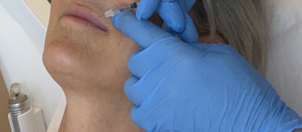 Lippenunterspritzung mit Hyaluronsäure bei Dr. Sarah Ophoff am Tegernsee, Nahaufnahme der Behandlung