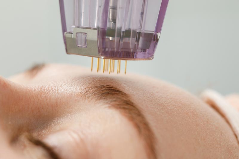 microneedle-mesotherapy-woman-receiving-micro-needling-rejuvenation-treatment-cosmetology-clinic-mod microneedle-mesotherapy-woman-receiving-micro-needling-rejuvenation-treatment-cosmetology-clinic-mod